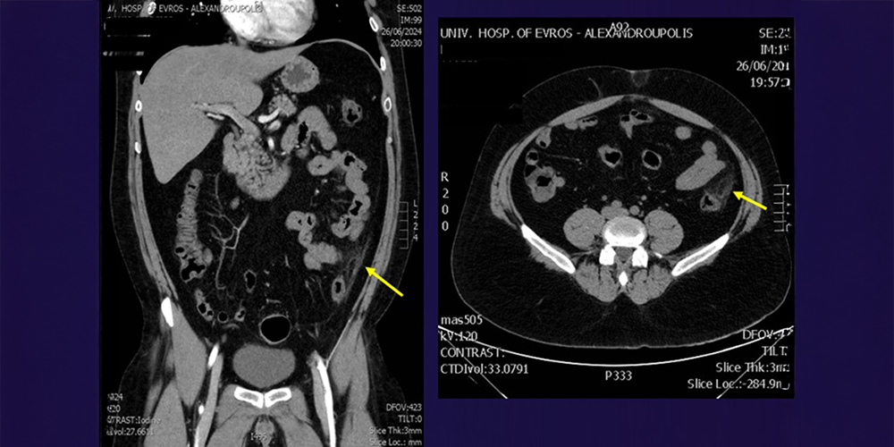 Epiploic appendagitis: The great mimicker of acute abdomen