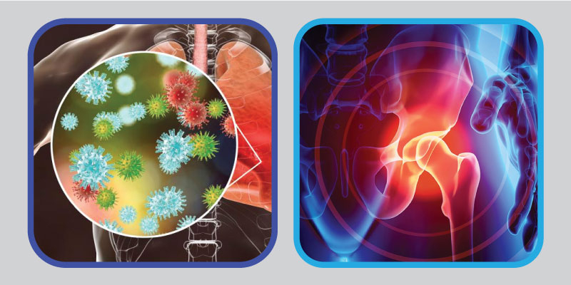 Acute respiratory infections, frailty and sarcopenia